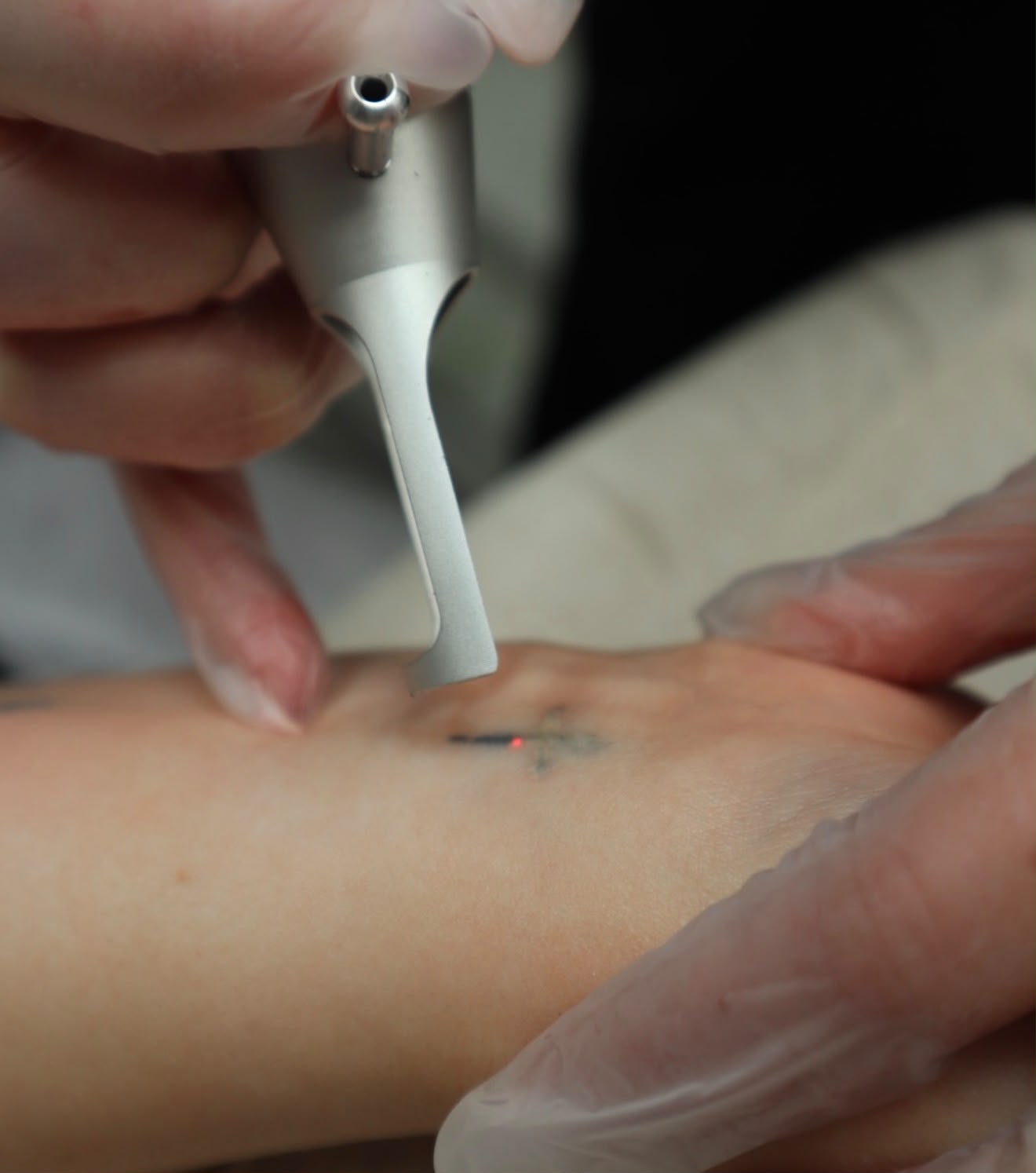Forearm tattoo before and after Pico laser tattoo removal in Cumbria