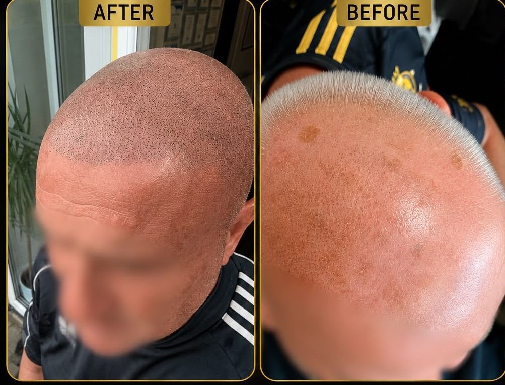 Before and after scalp micropigmentation adding natural density across the hairline and crown at Cumbria Scalp Clinic, Workington